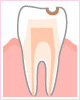 C1　エナメル質の入れ歯